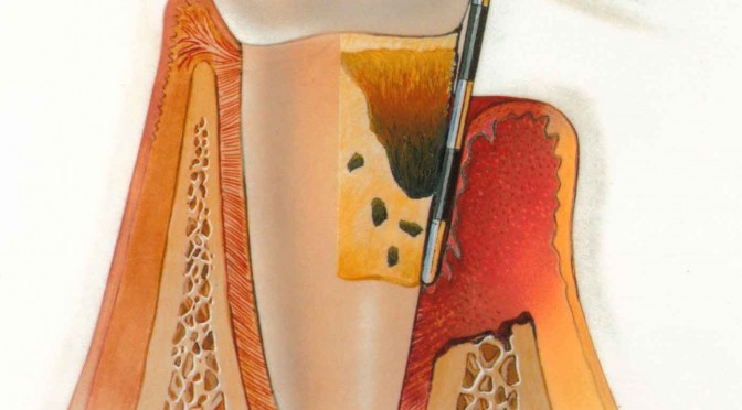 Sintomas da Doença Periodontal